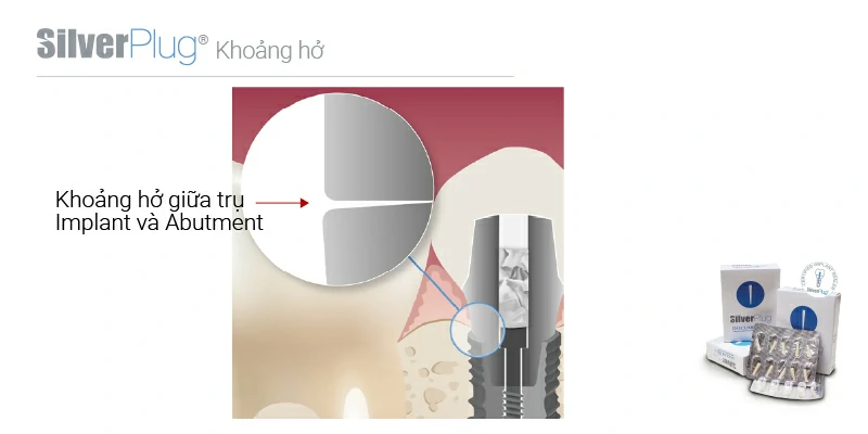 Kẻ hở giữa trụ implant và abutment