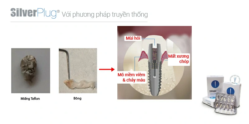 Vấn đề thường gặp khi sử dụng vật liệu thông thường khu vực lỗ vít Abutment